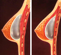 placement of breast implants either above or below the pectoralis muscle