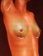 Location of incisions for breast augmentation